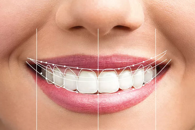 smile design software